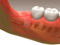 extractions_01