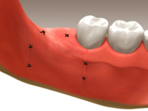 extractions_03