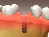 implant_restoration_02