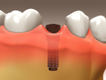 implant_restoration_03