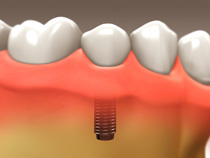 implant_restoration_04