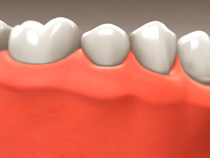 implant_restoration_05