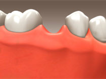 implant_restoration_06