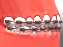 invi_braces_01