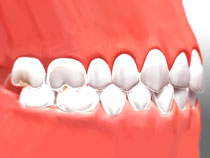 invi_braces_02
