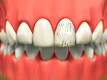 porcelain_veneers_01