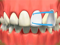 porcelain_veneers_02
