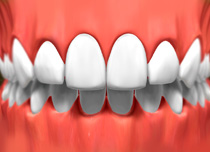 porcelain_veneers_03