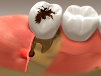 root_canal_01