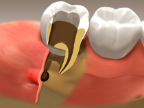 root_canal_02