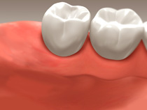 root_canal_05