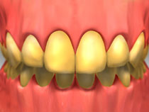 teeth_whitening_01