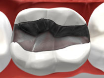 tooth-colored_01