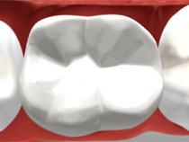 tooth-colored_02