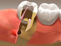 root_canal_03