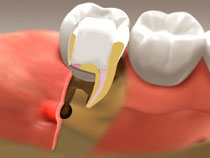 root_canal_04