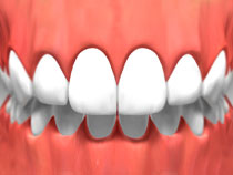 teeth_whitening_02